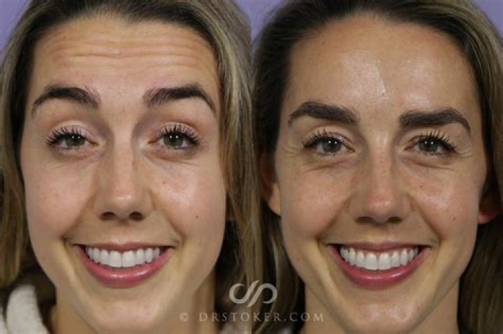 Botox los angeles - How To Discuss