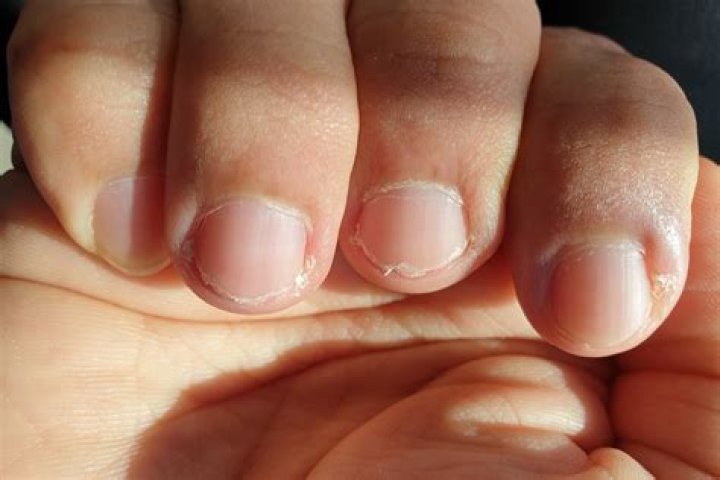 Curved Nails Vitamin Deficiency - How To Discuss