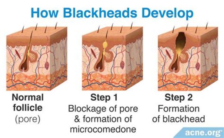 Deep blackheads - How To Discuss