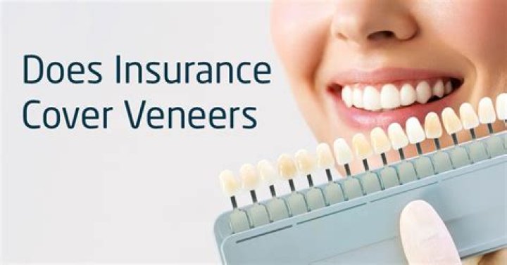 DOES INSURANCE COVER VENEERS:** - How To Discuss