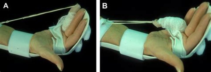 Does It Cost To Repair Flexor Tendon