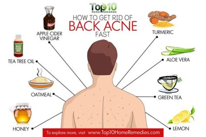 How to clear back acne