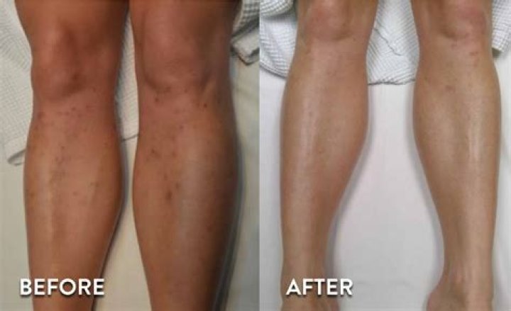 Leg hair removal - How To Discuss
