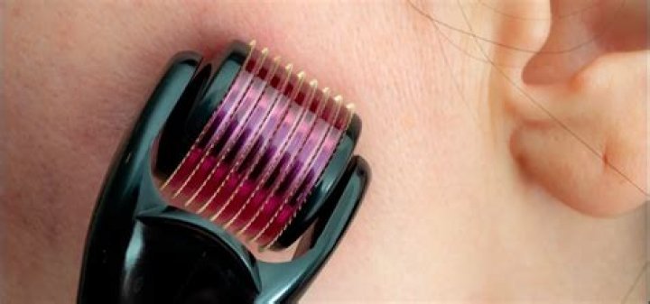 Microneedle face roller - How To Discuss