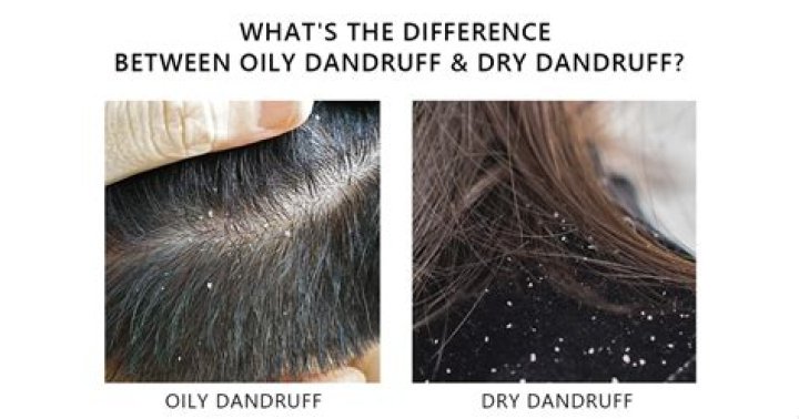 Oily dandruff - How To Discuss