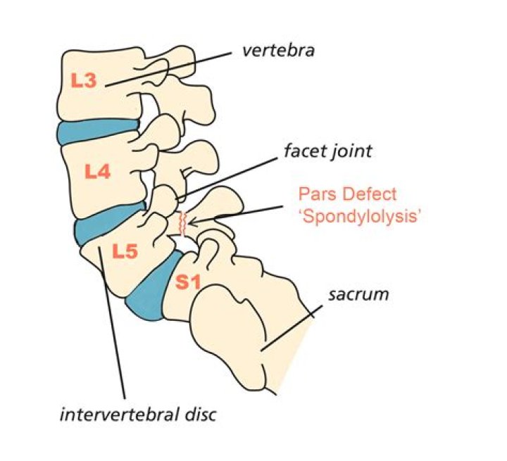 Pars Defect - How To Discuss