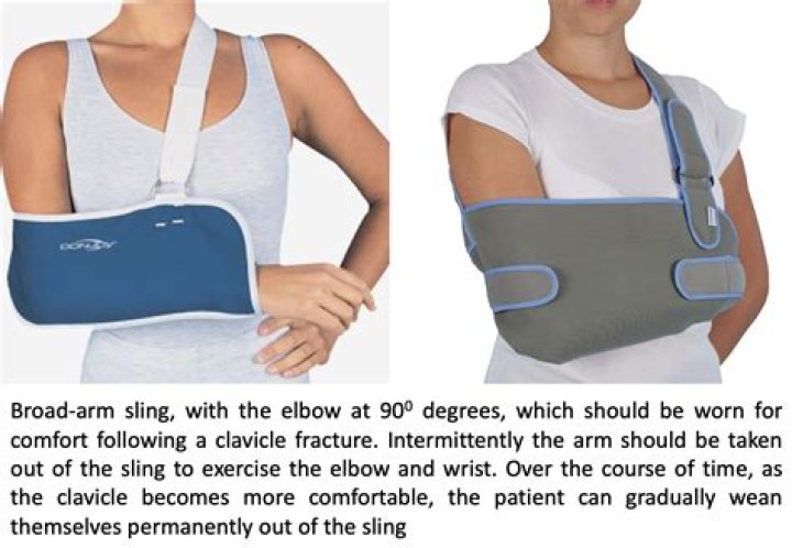 Question: How To Put On A Sling For Broken Collarbone