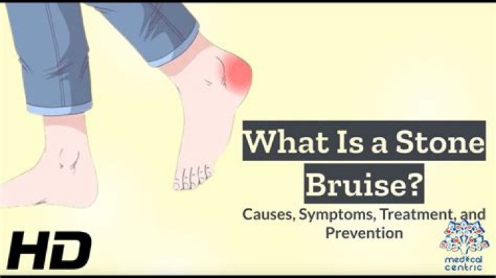 Quick Answer: How To Get Rid Of A Stone Bruise